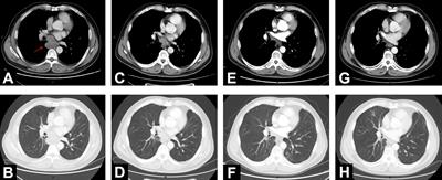 Case Report: First Case of Consolidation Immunotherapy After Definitive Chemoradiotherapy in Mediastinal Lymph Node Metastatic Sarcomatoid Carcinoma